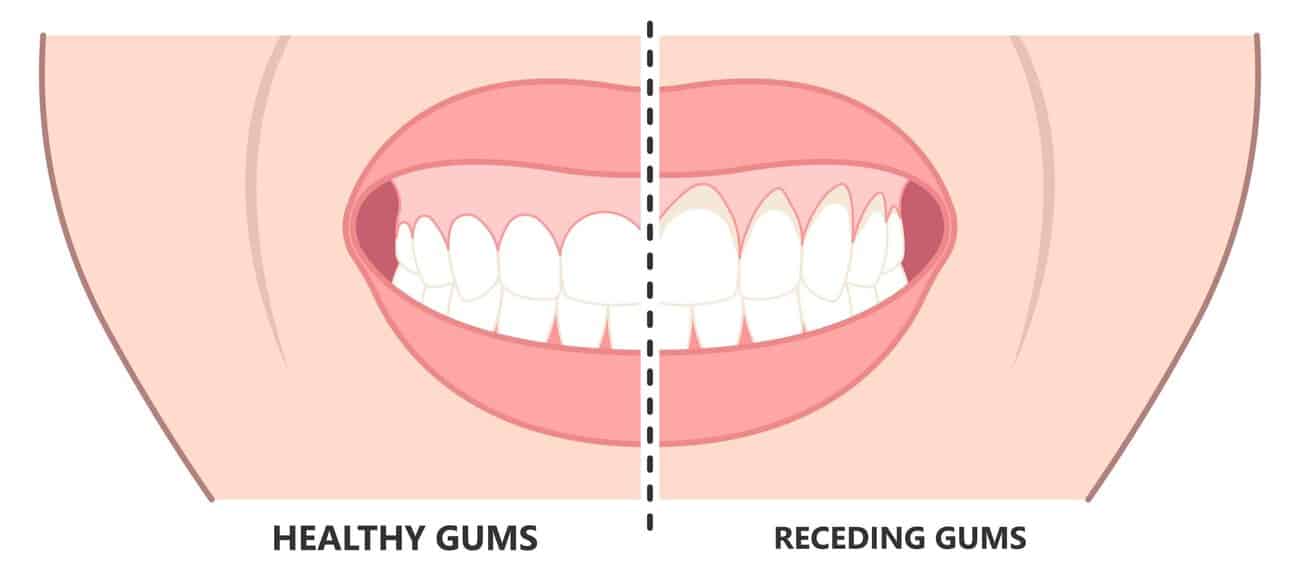 What Causes Gums to Recede Over Time Barnsley
